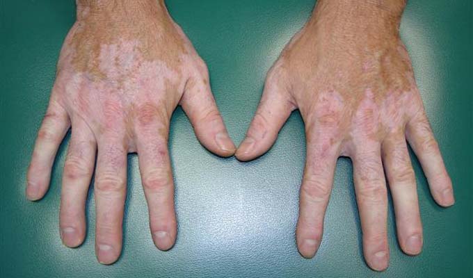 Vitiligo-maladie-peau