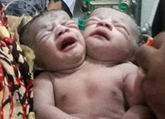 Naissance d’un bébé avec deux têtes au Bangladesh