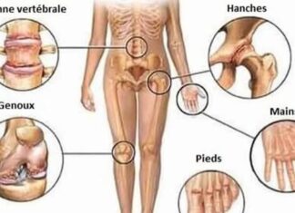 Tunisie – Santé : l’arthrose, un problème majeur affectant 30 % des Tunisiens