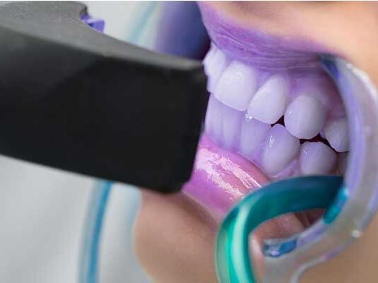 Tunisie : alerte contre les services informels de blanchiment dentaire