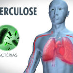 OMS : La tuberculose en 2023 atteint un record avec 8,2 millions de nouveaux cas