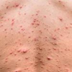 Le Monkeypox virus préoccupe la communauté scientifique mondiale