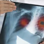 Tunisie : une étude révèle l’impact critique du diagnostic tardif sur le cancer du poumon avancé