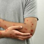 Résurgence de la rougeole en Europe : l’OMS alerte sur une multiplication par 30 des cas
