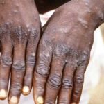 Mpox : La communauté internationale face à une recrudescence alarmante Mpox