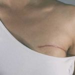 Octobre rose : les femmes en situation de handicap ont un accès limité au dépistage du cancer ?