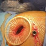 Sfax : Une avancée médicale majeure pour le traitement des tumeurs cardiaques