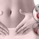 Papillomavirus humain : 80 à 90 % des personnes infectées, le vaccin reste la clé de prévention