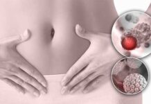 Papillomavirus humain : 80 à 90 % des personnes infectées, le vaccin reste la clé de prévention