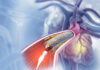 Tunisie : un cahier des charges national pour l’achat des stents cardiaques