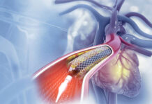 Tunisie : un cahier des charges national pour l’achat des stents cardiaques