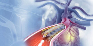 Tunisie : un cahier des charges national pour l’achat des stents cardiaques