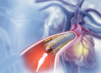 Tunisie : un cahier des charges national pour l’achat des stents cardiaques